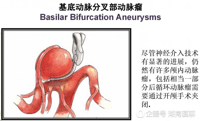 中南腦血管病大會，專家都講了哪些最新研究成果？