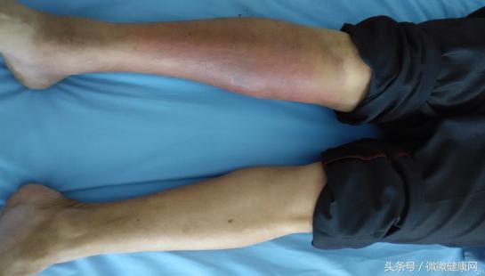 糖尿病足早期會出現這些症狀,別等到截肢了才後悔