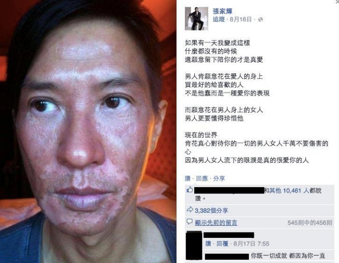 張家輝的臉竟然變成這個樣子，把粉絲們全都嚇壞了！他難過的PO了「這段話」令大家看完都哭了...