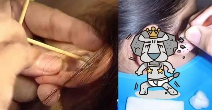 醫師清耳朵挖出「巨大化石」！他驚「世界完全不一樣了」...大驚呼：原來這麼吵！