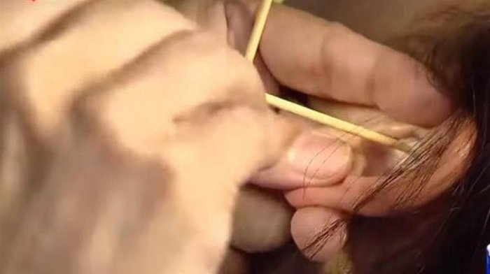 醫師清耳朵挖出「巨大化石」！他驚「世界完全不一樣了」...大驚呼：原來這麼吵！