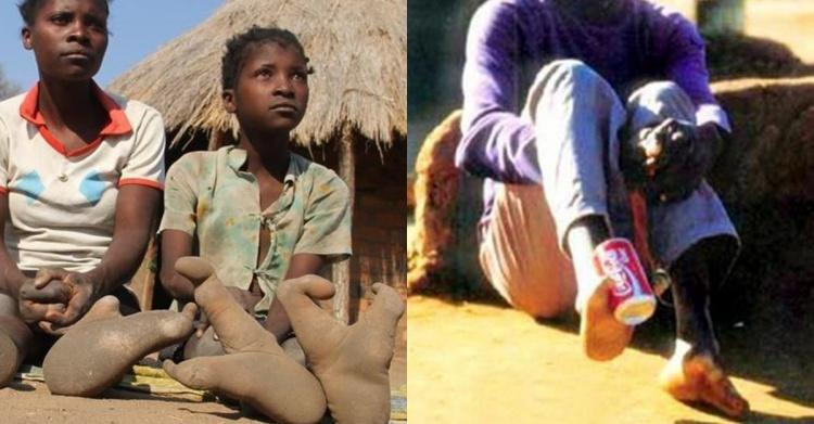 天生只有兩個腳趾!非洲「龍蝦族」鉗子腳掌拿可樂超方便…至今仍在尋找同類(6P+影)