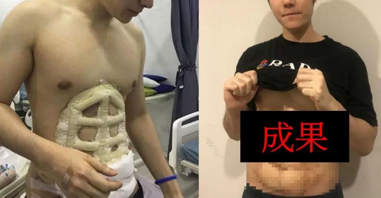 我看了什麼!整形醫院推「六塊肌速成手術」僅2個小時….大驚:弱雞→變猛男!