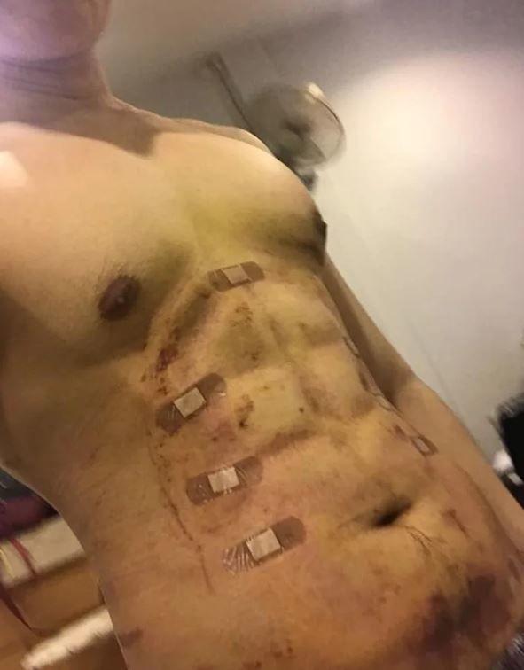 我看了什麼!整形醫院推「六塊肌速成手術」僅2個小時….大驚:弱雞→變猛男!