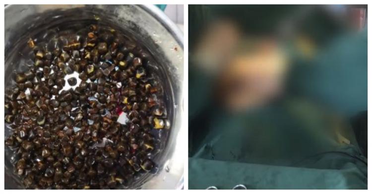 東西真的不要亂吃！陸男肚子痛就醫「取出504顆結石」…醫師曝:「驚人原因」!