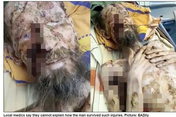 他被棕熊綁架1個月當食物！全身爛肉乾皮「變喪屍」...奇蹟存活