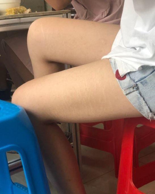 懷疑女友生過… 瞎男PO腿照扯問「有妊娠紋難道？」網眼尖氣狂譙…劇情神反轉：分了吧
