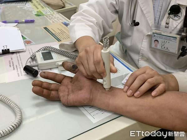 比肺癌更恐怖！抽菸「雙指發黑」慘截肢...醫曝嚴重會切GG