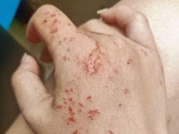 慎入！她起床驚見手被蟑螂咬滿傷疤 驚曝原因竟是…