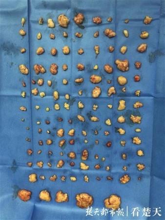 熬夜打麻將!41歲女全身冒出200個「小山丘」 求醫挖出一堆「XX」嚇壞