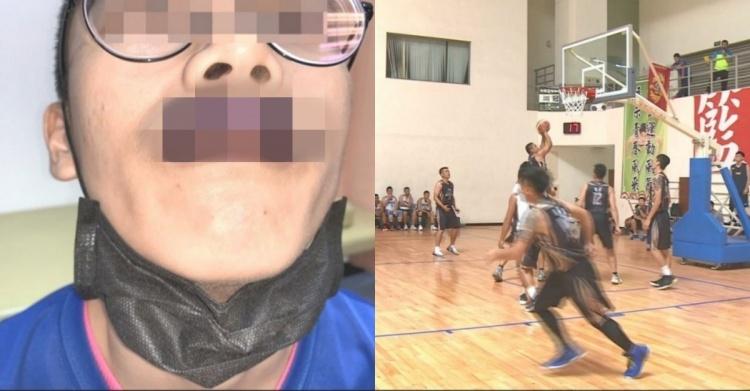 超噁心畫面...熱血打球被肘擊「嘴唇直接踵成士林大香腸」整條發紫...:以為在看卡通