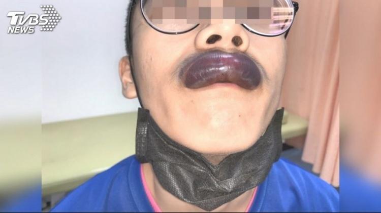 超噁心畫面...熱血打球被肘擊「嘴唇直接踵成士林大香腸」整條發紫...:以為在看卡通