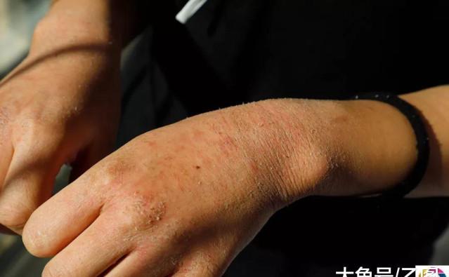 考上醫師卻得絕症...男提分手女大生暴哭不肯「我等你娶我等八年了！」網友看了也全哭了