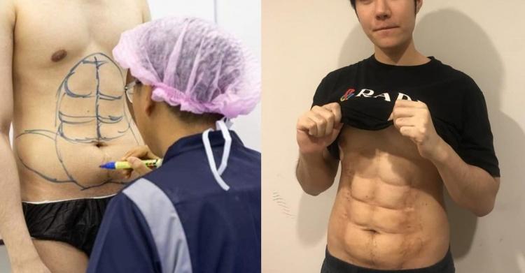 泰國醫院有做特別的服務！瞬間讓你「六塊腹肌飽滿」線條完美...讓全場爭先恐後報名！