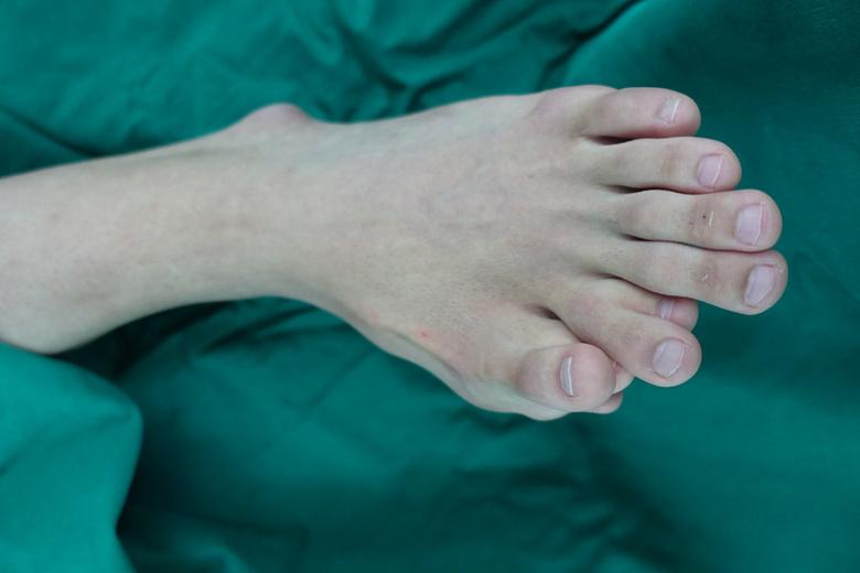 男子患百萬分之一怪病...超驚悚「一隻腳長九根腳趾頭」鞋子也穿不下...網嚇歪:好可怕!