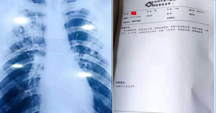 強國老師為了假期做了這種事!線上購買「假結核病診斷」曝光...引起全國人民撻伐!