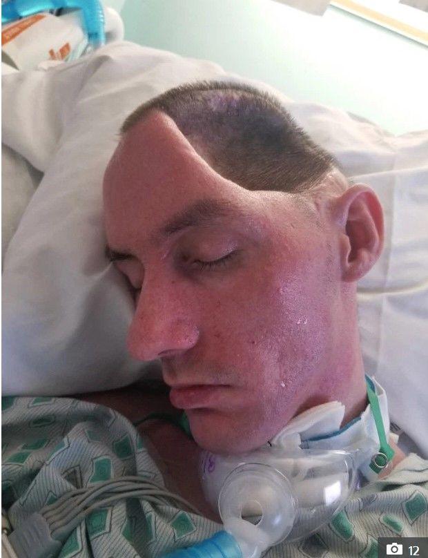 紐約一名男子慘遭球棒痛擊!駭人照曝「左腦殘缺」…惡男:只揮一下拳…72天後出獄!