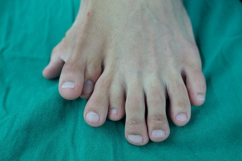 男子患百萬分之一怪病...超驚悚「一隻腳長九根腳趾頭」鞋子也穿不下...網嚇歪:好可怕!