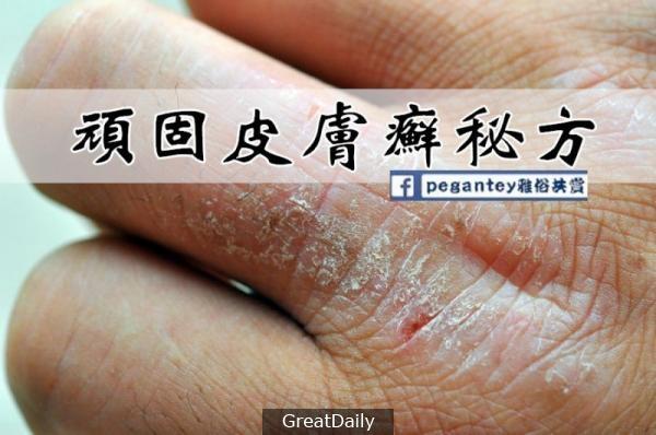 【頑固皮廯秘方】，歡迎轉發！