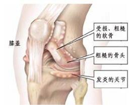 十個骨頭疼,九個有積液!白酒配瓜子,用一次管一輩子,永不復發