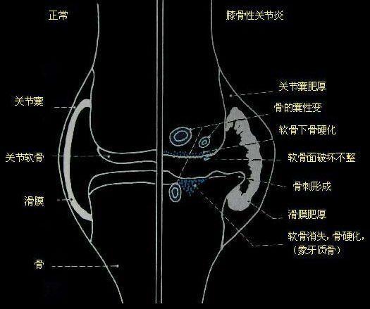 十個骨頭疼,九個有積液!白酒配瓜子,用一次管一輩子,永不復發