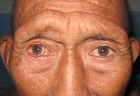 血脂越高壽命越短，擊敗高血脂你只要做3件事，不用吃藥！