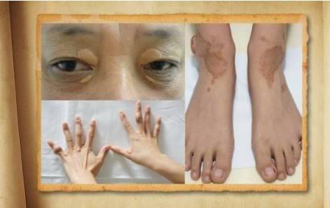 血脂越高壽命越短，擊敗高血脂你只要做3件事，不用吃藥！