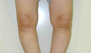 十個骨頭疼,九個有積液!白酒配瓜子,用一次管一輩子,永不復發