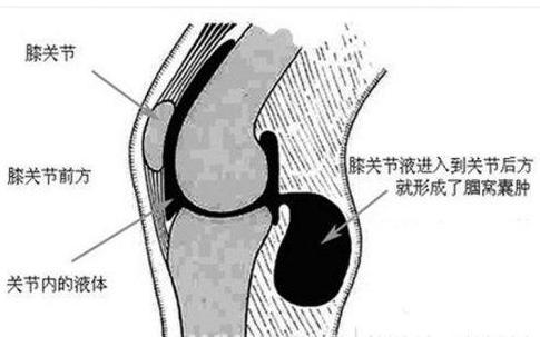 十個骨頭疼,九個有積液!白酒配瓜子,用一次管一輩子,永不復發