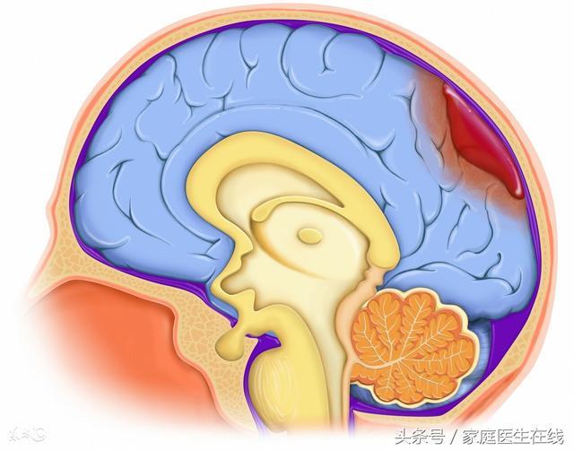 發生腦出血前，身體一個地方會「變硬」，一個地方會「變軟」！