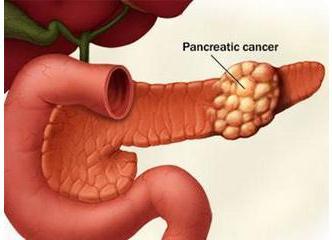 糖尿病忽變胰腺癌,42歲霸道總裁哭崩潰,醫生說都是這些食物吃太多