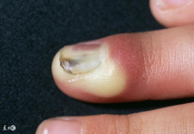 中醫坦白:肝不好的人,這3個部位會發黑!秋季多吃3種改善肝功能的食物!