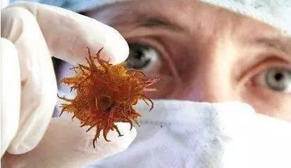 腫瘤也挑人,常吃5種食物,癌症也要繞道走