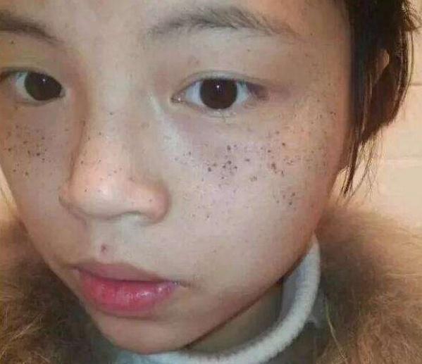滿臉斑點也不要放棄，用到處都有的液體擦一下，斑點剝落如換臉