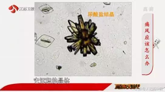 手上出現這些特徵，竟是骨關節病信號！千萬別忽視