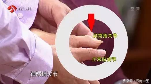 手上出現這些特徵，竟是骨關節病信號！千萬別忽視