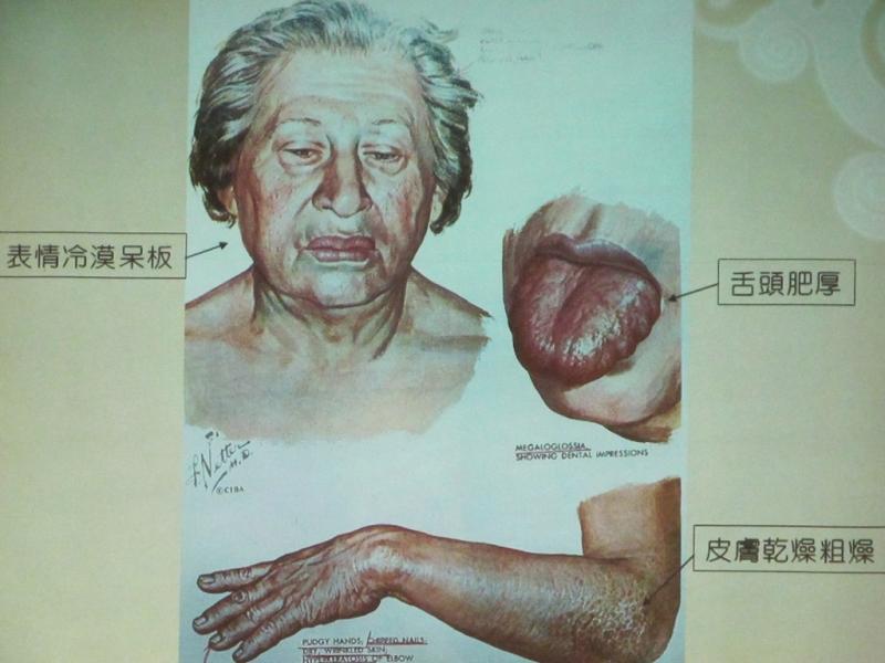 「甲狀腺」疾病千萬要避開「4類食物」！越吃脖子越腫嚇死人....