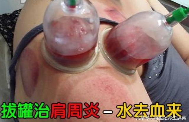 肩周炎的四大類型及其治療方法，快轉給身邊需要的人~