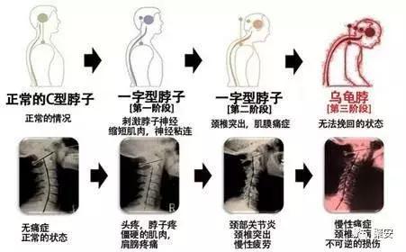 治好頸椎病的幾個小方法，一學就會，趕快試試