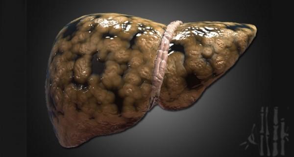 為什麼「肝癌」一發現就是晚期？如果有「這3種症狀」 就一定要注意了！