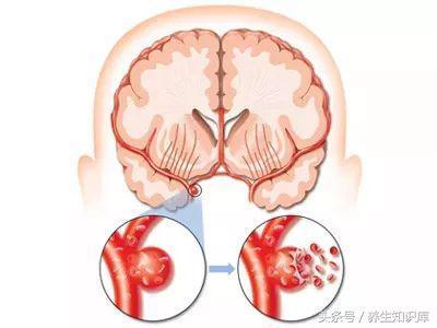 警惕:腦血管要「崩潰」的10大信號,早發現,或許能救命!