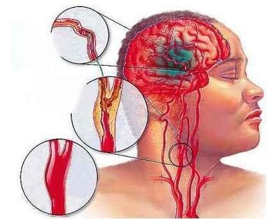 中風、腦梗、心梗、腦溢血等心腦血管疾病，兩個手指可應急救治！