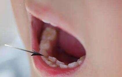 6歲女童長出「雙排牙」 原因太意外了！別讓你的孩子不小心「中招」
