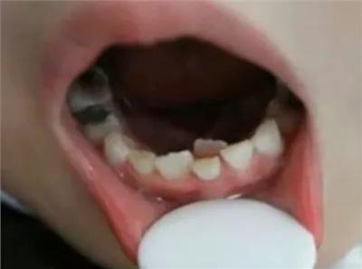 6歲女童長出「雙排牙」 原因太意外了！別讓你的孩子不小心「中招」