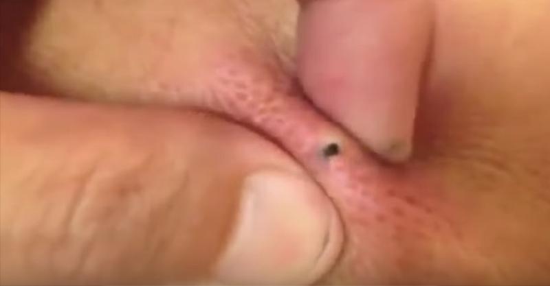 讓你感到完全紓壓的「各種擠痘痘、粉刺」大合輯，還是用手擠爆最有感！