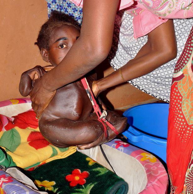 這個19歲女孩在6個月大時「身體就莫名停止生長」終生只能住在臉盆裡，看到她的身體連醫生都不敢相信…