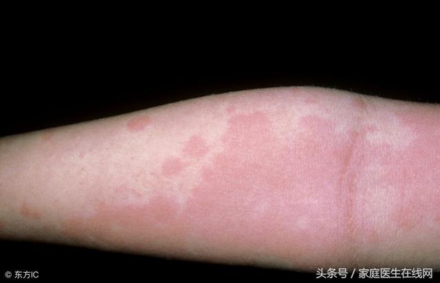 蕁麻疹是由什麼引起的？ 這4個「禍首」，哪個都別小看