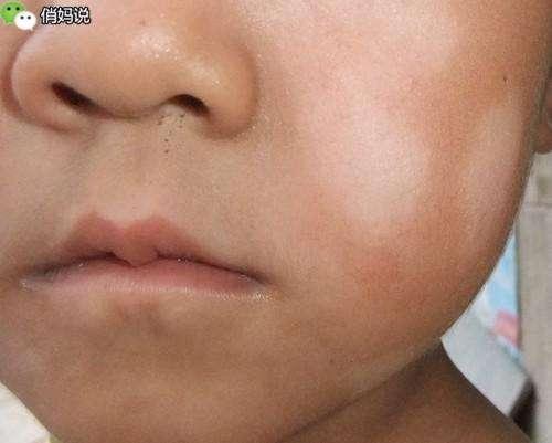 仔細看看，你家小孩臉上有「這種白斑」嗎？這個竟是......
