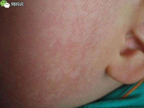 仔細看看，你家小孩臉上有「這種白斑」嗎？這個竟是......