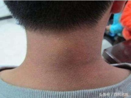 脖子黑洗不淨需注意！這是「黑棘皮症」，恐是大病征兆！